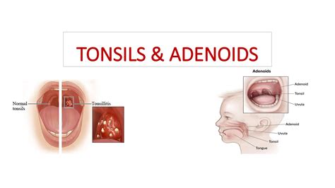 Tonsillitis new.pptx adenoids - ENT , adenoids hypertrophy and tonsillitis | PPTX
