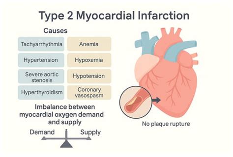 Type 2 Myocardial Infarction: Navigating Diagnostic Pathways and ...