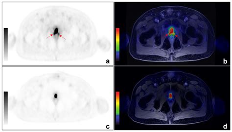 68Ga-PSMA and 68Ga-DOTA-RM2 PET/MRI in Recurrent Prostate Cancer ...