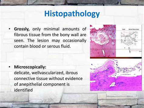 Traumatic bone cyst | PPTX