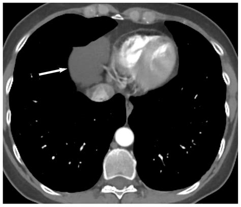 Approach to Imaging of Mediastinal Masses