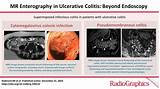 MR Enterography in Ulcerative Colitis: Beyond Endoscopy | RadioGraphics