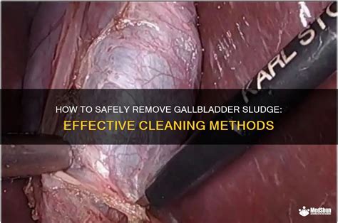 Image result for How to Remove Gallbladder Sludge