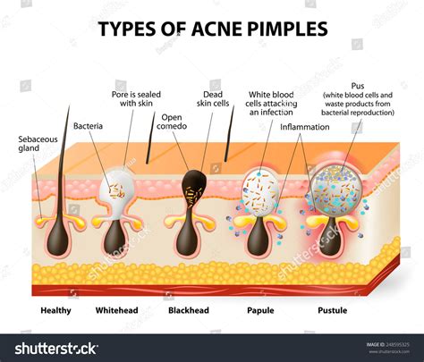 Types Acne Pimples Healthy Skin Whiteheads Stock Vector 248595325 - Shutterstock