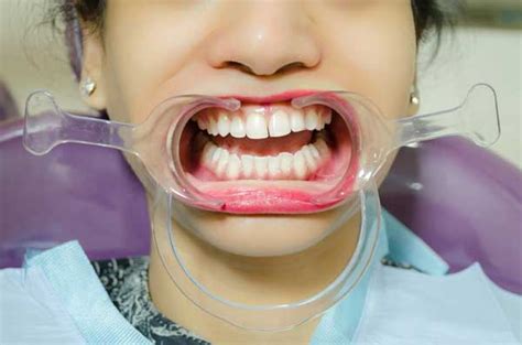 Advanced Endodontics Courses in Delhi, India | AADEINDIA