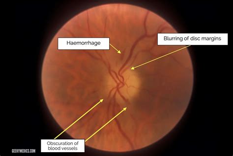 Optic Nerve Eye Hemorrhage at Eula Seay blog