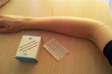 एक्यूपंक्चर के फायदे, बिंदु और साइड इफेक्ट - Acupuncture In Hindi