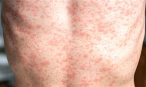 US faces resurgence of measles cases as vaccination rates decline: Study