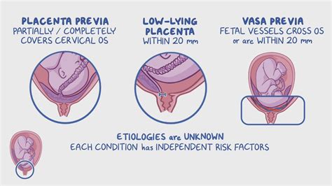 Video: Placenta previa and vasa previa: Clinical sciences | Osmosis