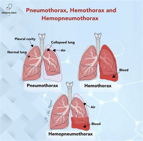 Hemothorax Vs Pneumothorax Hemothorax: Causes, Symptoms, Treatment And