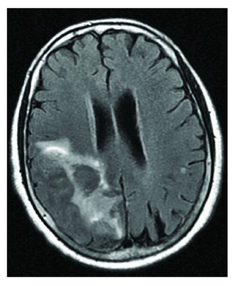 Image result for Alien Arm Syndrome