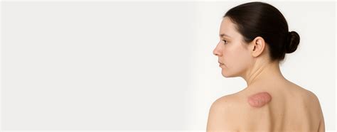 Keloid Scar Removal | Advanced Scar Treatments at Dermatrix