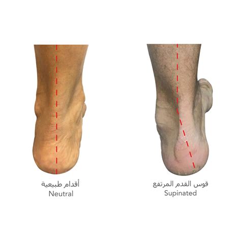 Flat Foot Center | Dubai Podiatry Centre