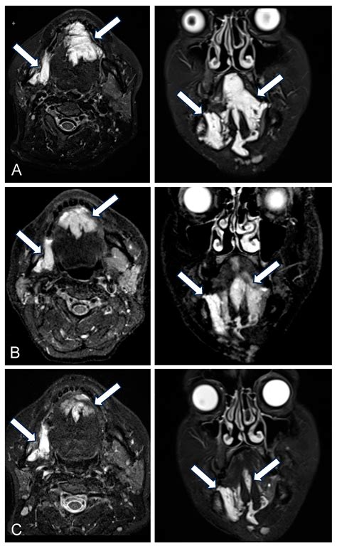 Bleomycin Electrosclerotherapy (BEST) for Slow-Flow Malformations of ...