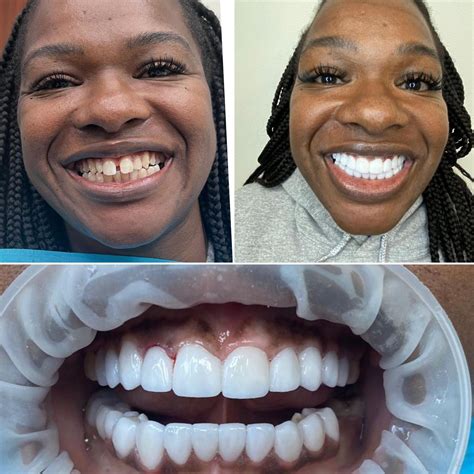 Porcelain Veneers in Miami – Miami Cosmetic Smile Design