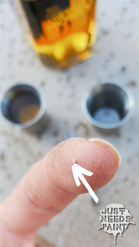 Image result for Remove Splinter