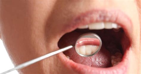 Oral Cancer - IPN Delhi India
