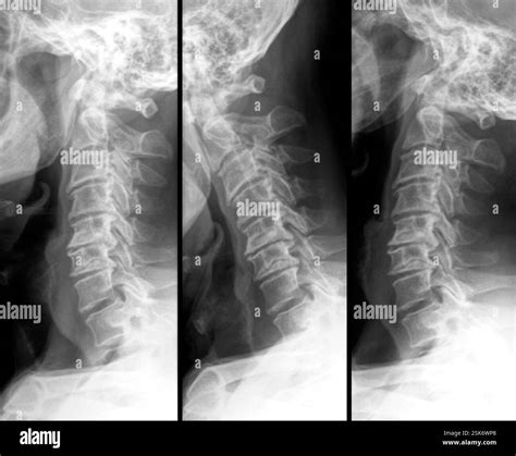 X-ray (side view, flexion and extension) of the cervical vertebrae of the neck showing narrowed ...