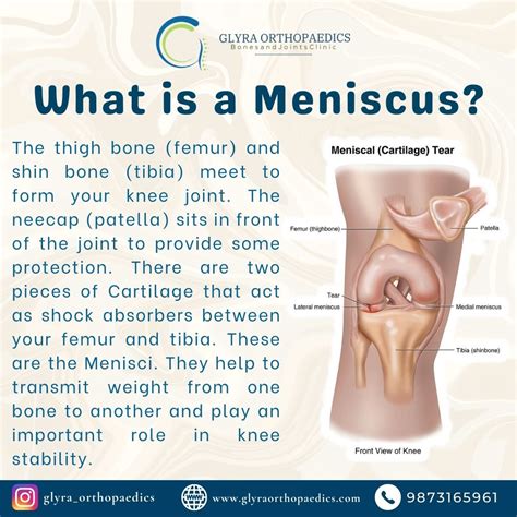Glyra Orthopaedics on LinkedIn: #meniscus #injury #symptoms #doctor #swelling