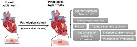 Hypertrophy Of The Heart