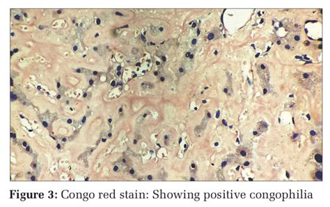 Hepatic Amyloidosis – A Clinicoradiological Dido