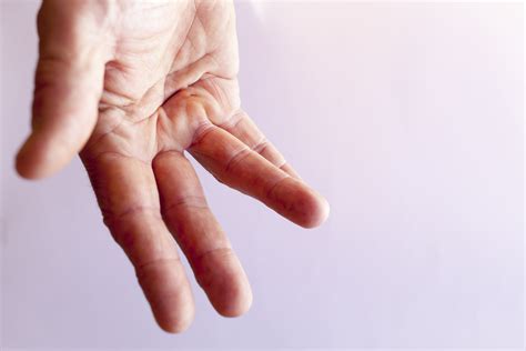 Bildergebnis für dupuytren's surgery pictures