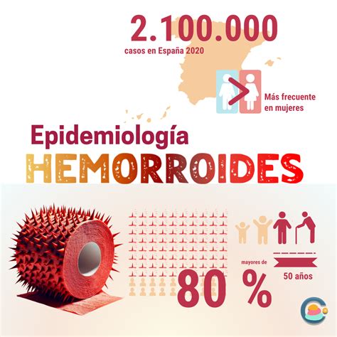 Hemorroide En El Ano