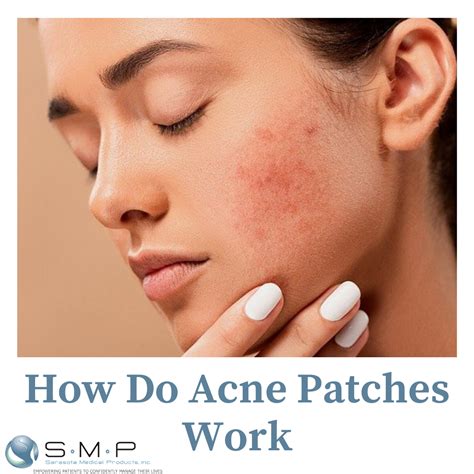 How Do Acne Patches Work | Medical Device Manufacturing Company FL