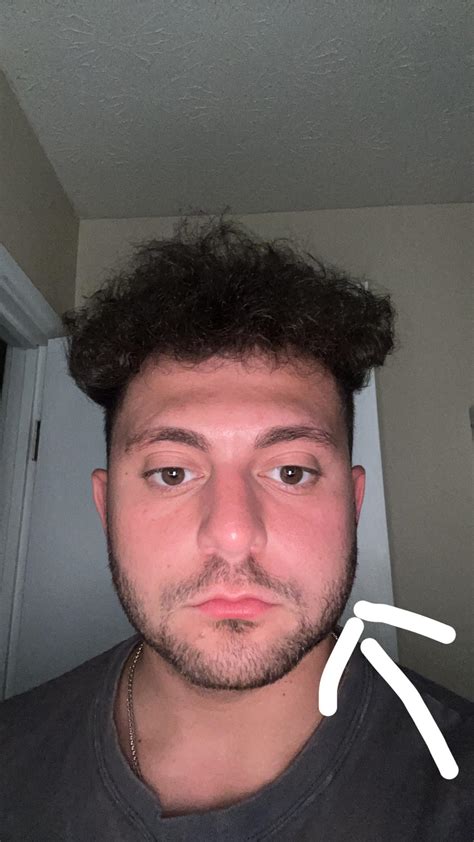 Face swelling on one side : r/Sinusitis