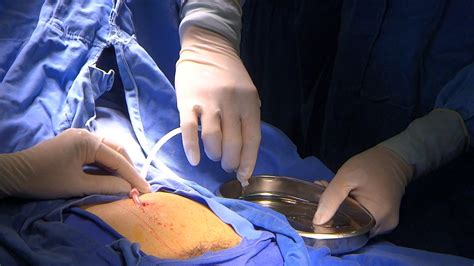 超声下经皮穿刺腹透导管植入（附视频） - 知乎