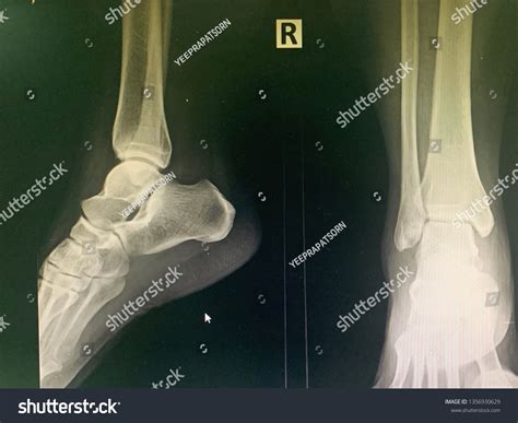 Normal Ankle Lateral Anterior View Xray Stock Photo 1356930629 ...