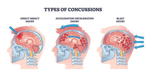 concussions #5592549 | Clipart Library
