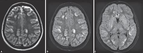 COVID-19-associated Severe Multisystem Inflammatory Syndrome in ...