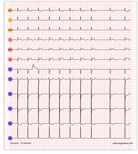 Second-degree AV block: Mobitz type 1 (Wenckebach) & Mobitz type 2 block – The Cardiovascular