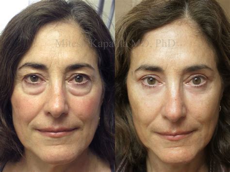 Before and four months after upper and lower blepharoplasty surgery ...