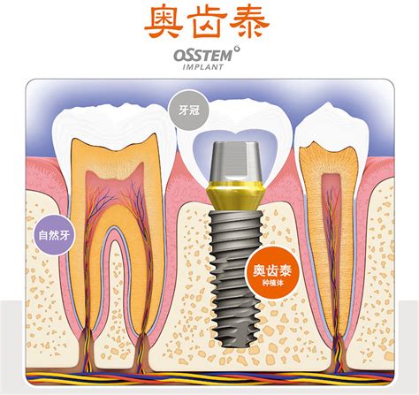 武汉仁爱的韩国Dentium种植牙价格竟低到1999元-活动限三天 - 武汉仁爱医院口腔科 - 开立特口腔