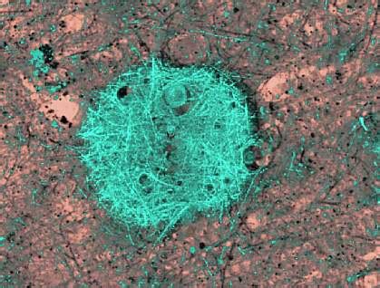 Non-Infectious Prion Protein Linked to Alzheimer’s Disease | National ...