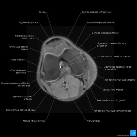 Resonancia magnética de rodilla: qué se ve en una RMN