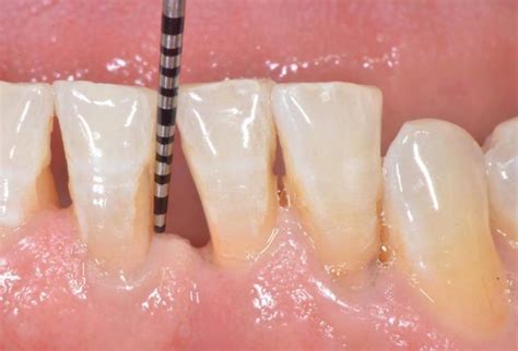 Image result for Tooth Mobility Problem