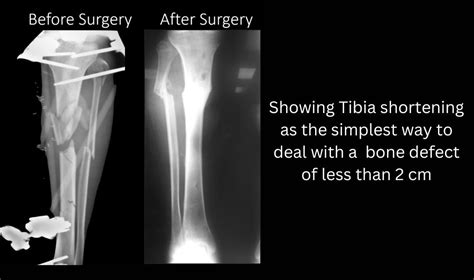 Nonunion and Management of Bone loss Treatment in Delhi