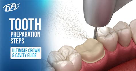 Tooth Preparation Steps: Ultimate Crown & Cavity Guide – Dental Avenue
