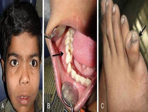 GORLIN GOLTZ SYNDROME: AN ENIGMA|SDCINDIA