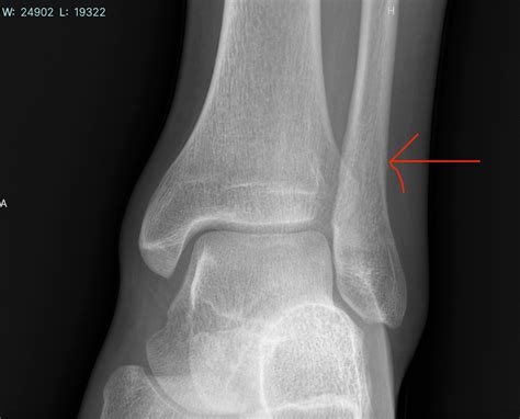 Fibula stress fracture not noticed for 3.5 weeks : r/brokenbones
