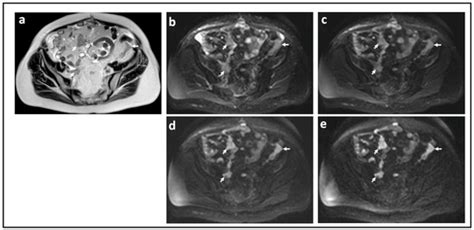 Diffusion-Weighted Magnetic Resonance Imaging in Ovarian Cancer ...