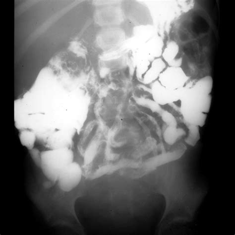 Pediatric Radiation Induced Enteritis | Pediatric Radiology Reference Article | Pediatric ...