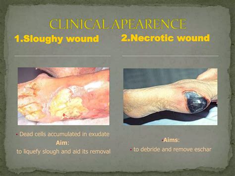 Wound management & dressings | PPTX