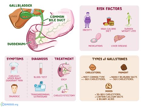 Choledocholithiasis: What Is It, Causes, Diagnosis, Treatment, and More | Osmosis