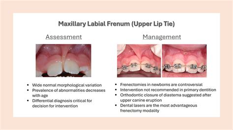 Superior Labial Frenulum