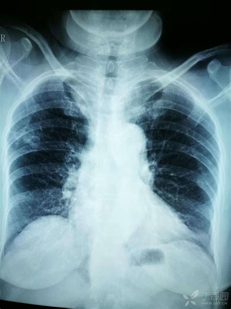 小片子肺部图片