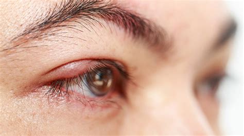 What Is a Stye? Causes, Treatment, and Other FAQs - GoodRx